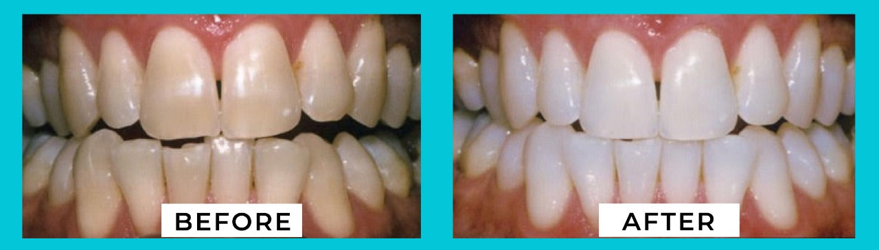 Mobile White Advanced Teeth Whitening VIP Kit