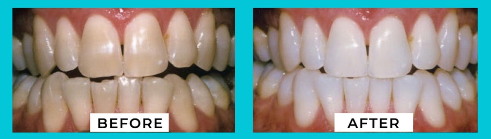 Mobile White Advanced Teeth Whitening VIP Kit